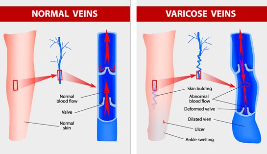 Endovenous Laser Vein Ablation Robert K Weiser Vascular Doctor Brooklyn Heights Ny 1952